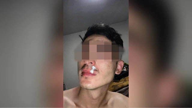 Alumnos de odontología de la UATx rompen botella en cabeza de otro joven